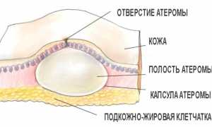 Лечение атеромы молочной железы: способы и средства, симптомы